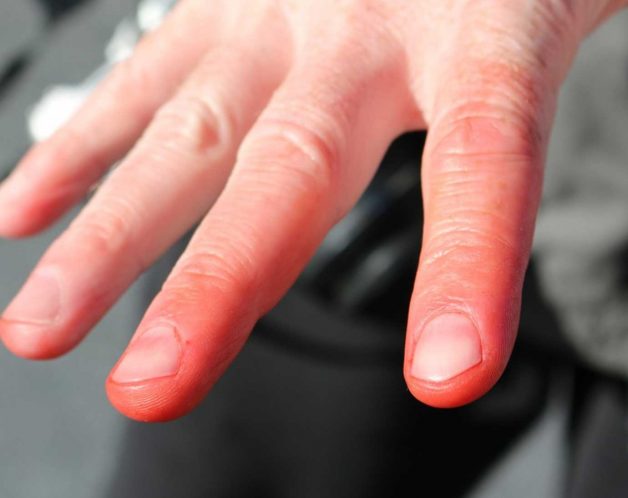 maladie-reynaud-mesotherapie-troubles-circulation-paris-dr-nguyen maladie-reynaud-mesotherapie-troubles-circulation-paris-dr-nguyen