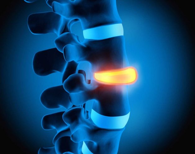 traitement-mesotherapie-nevralgie-sciatique-paris-dr-nguyen Névralgie sciatique par mésothérapie à Paris - Dr Nguyen