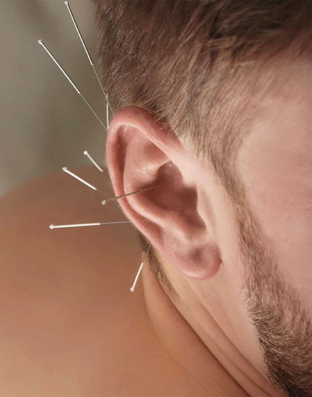 Pratique de l'acupuncture à Paris - Dr Nguyen