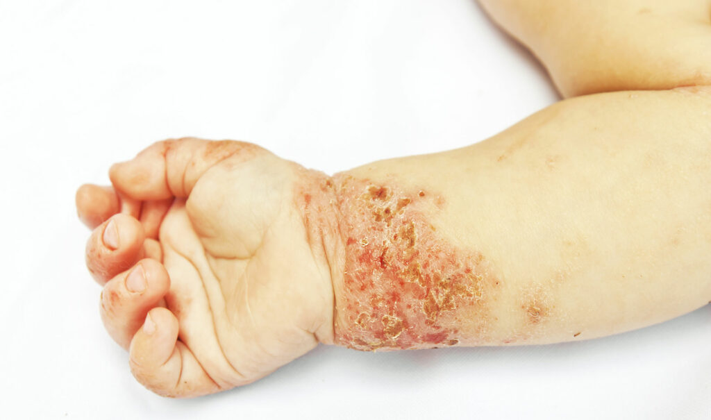 Problèmes de peau – eczéma par le dr Nguyen à Paris