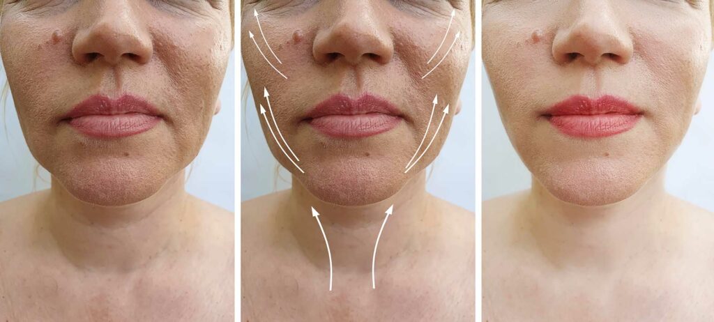 A quel âge peut-on faire des injections d'acide hyaluronique ?