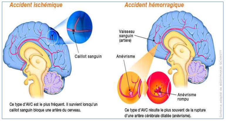 Les types d'AVC