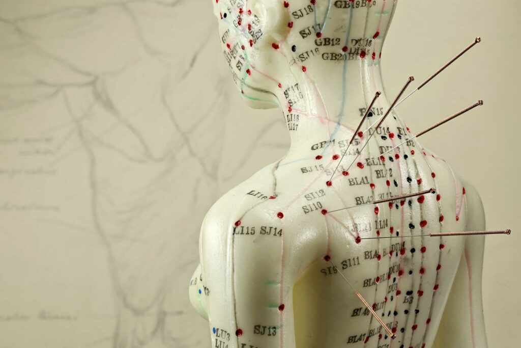 Acupuncture après AVC par le dr Nguyen à Paris