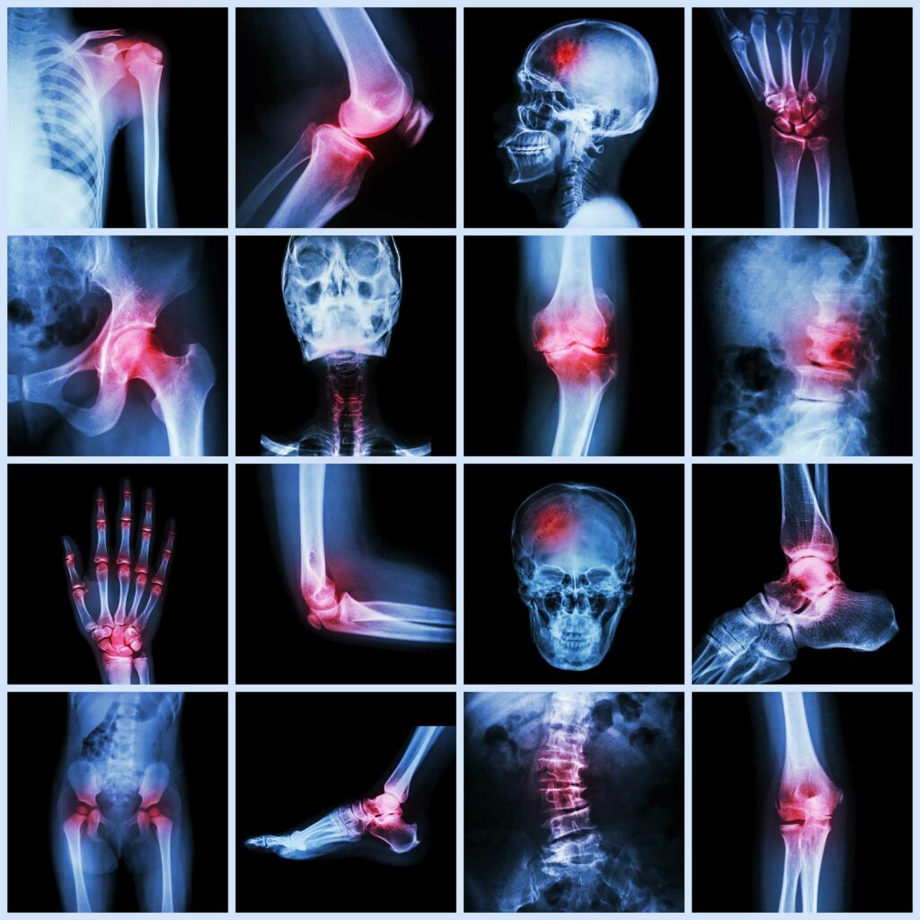 Acupuncture et Algodystrophie