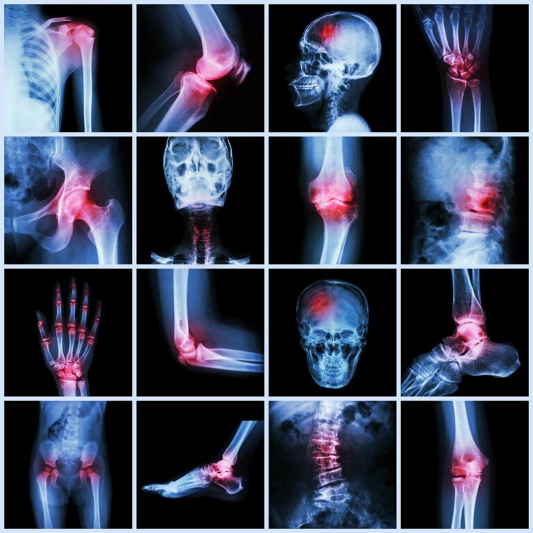 Acupuncture et Algodystrophie