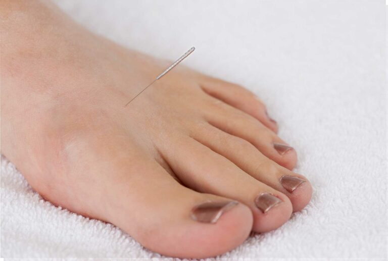 Algodystrophie : unifier corps et esprit grâce à l’acupuncture