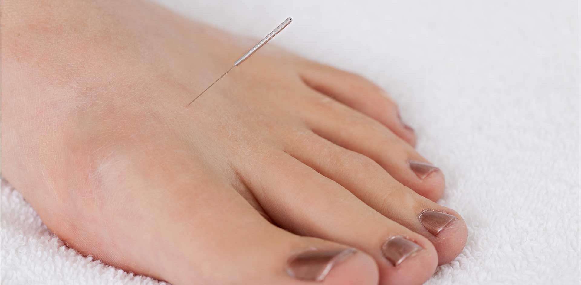 algodystrophie-acupuncture-paris-dr-nguyen Algodystrophie : unifier corps et esprit grâce à l’acupuncture