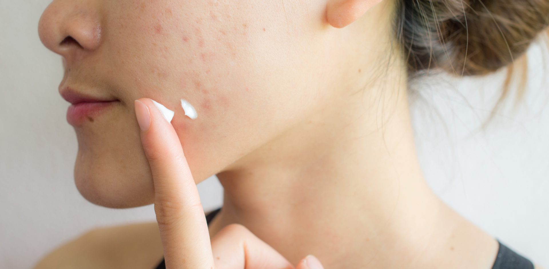 Shot of woman preparing for applying acne cream for solve her problem skin.