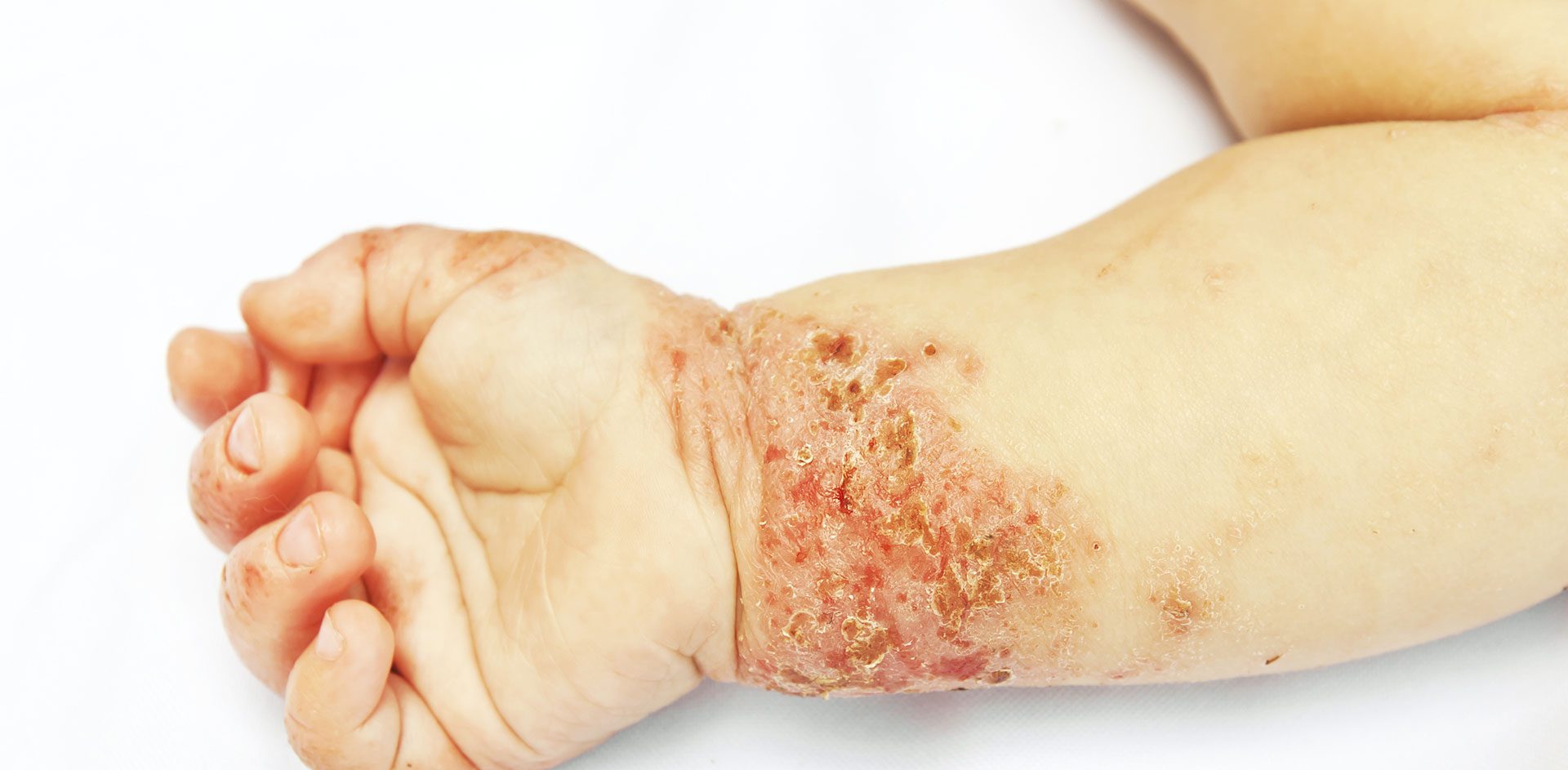 pediatrie-probleme-peau-exzema-dr-nguyen-paris Problèmes de peau – eczéma par le dr Nguyen à Paris